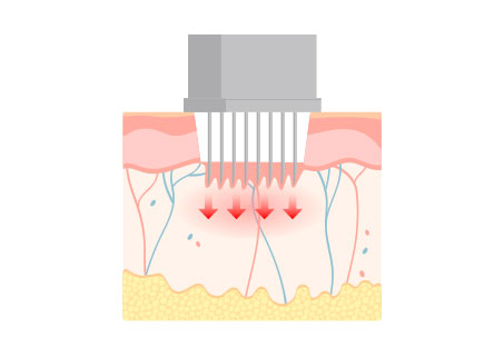 생기침 (RF/Fractional)